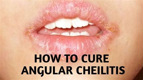 queilitis angular|Angular Cheilitis: Symptoms, Causes, Treatments